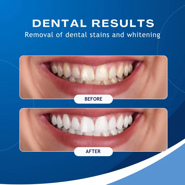 Alt view image 7 of 7 - Ultrasonic Electric Teeth Polisher - Rechargeable Dental Calculus & Plaque Remover with 5 Heads, 3 Modes, and LED Light for At-Home Dental Care