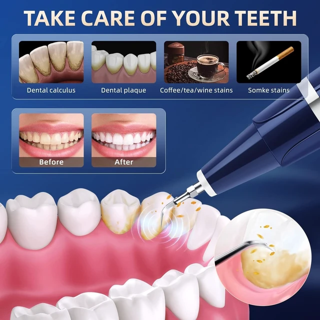 Alt view image 12 of 14 - Plaque Remover for Teeth - Tartar Remover for Teeth, Dental Calculus Remover Teeth Cleaning Kit