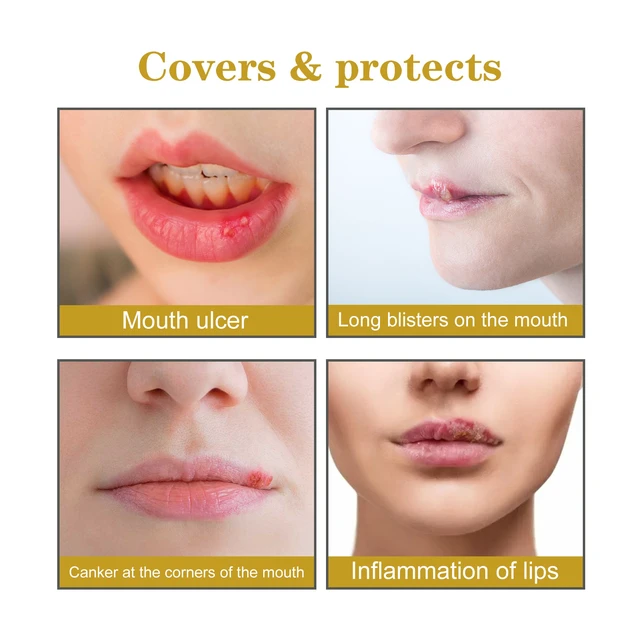 Alt view image 3 of 6 - Hydrocolloid Lip Care Patches for Cold Sore Relief and Healing