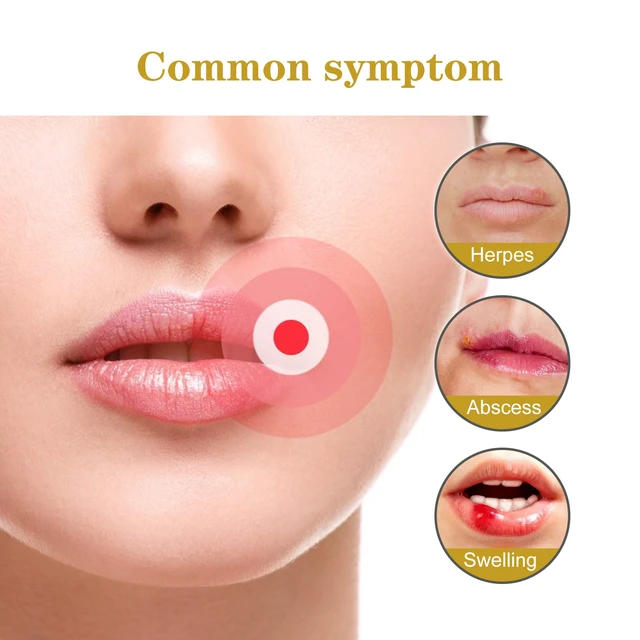 Alt view image 4 of 6 - Hydrocolloid Lip Care Patches for Cold Sore Relief and Healing