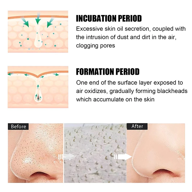 Alt view image 3 of 6 - Deep Cleansing Blackhead Remover Nose Strips Pore Acne Care Tear-Off Mask