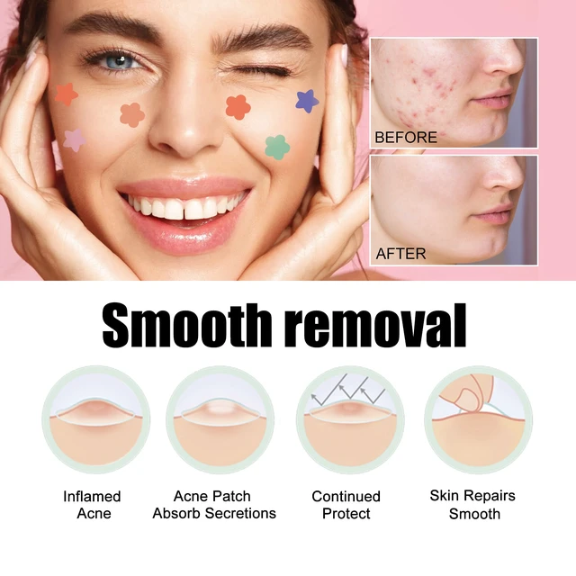 Alt view image 4 of 6 - West & Month Invisible Color-Shaped Acne Patches Portable Spot Treatment