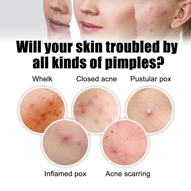 Alt view image 3 of 6 - West & Month Invisible Color-Shaped Acne Patches Portable Spot Treatment