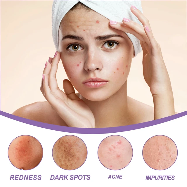Alt view image 3 of 7 - Perilla Ice Crystal Hydrating Gel Repair Acne Scars Deep Cleansing Moisturizer