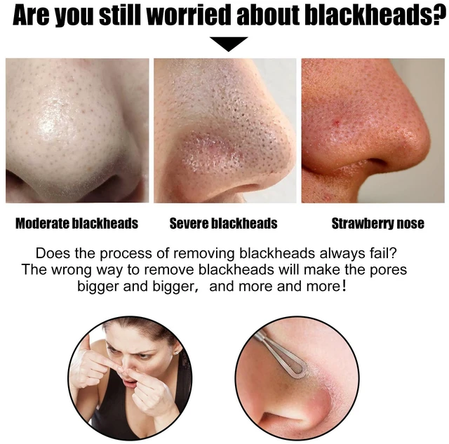 Alt view image 3 of 7 - Deep Cleansing Nose Strip for Blackhead and Acne Removal - Peel Off Pore Refining Mask