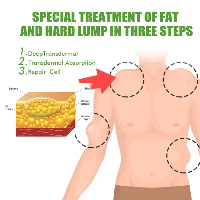 Alt view image 4 of 6 - Fat Knot Dissolving Cream - Body Care for Subcutaneous Lumps & Fatty Tumors