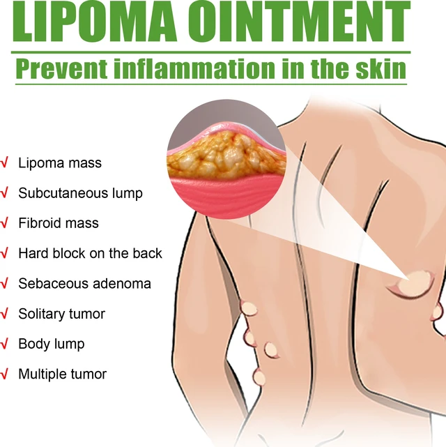 Alt view image 3 of 6 - Fat Knot Dissolving Cream - Body Care for Subcutaneous Lumps & Fatty Tumors