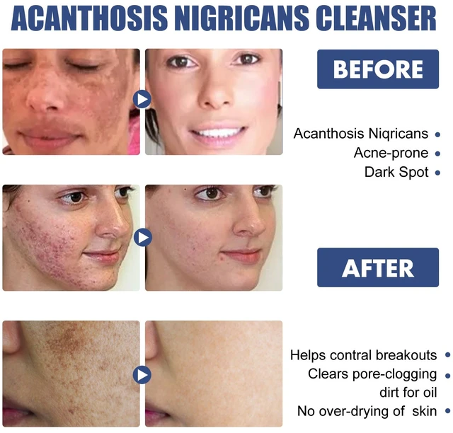 Alt view image 2 of 4 - Blackhead Remover Facial Deep Cleansing Oil Control Skin Repair Softening Wash