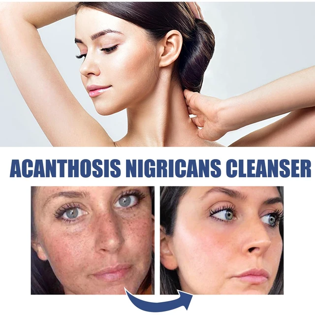 Main image of Blackhead Remover Facial Deep Cleansing Oil Control Skin Repair Softening Wash