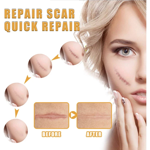 Alt view image 4 of 7 - Surgery & Wound Healing Repair Ointment, EELHOO Scar Removal Cream for Burns