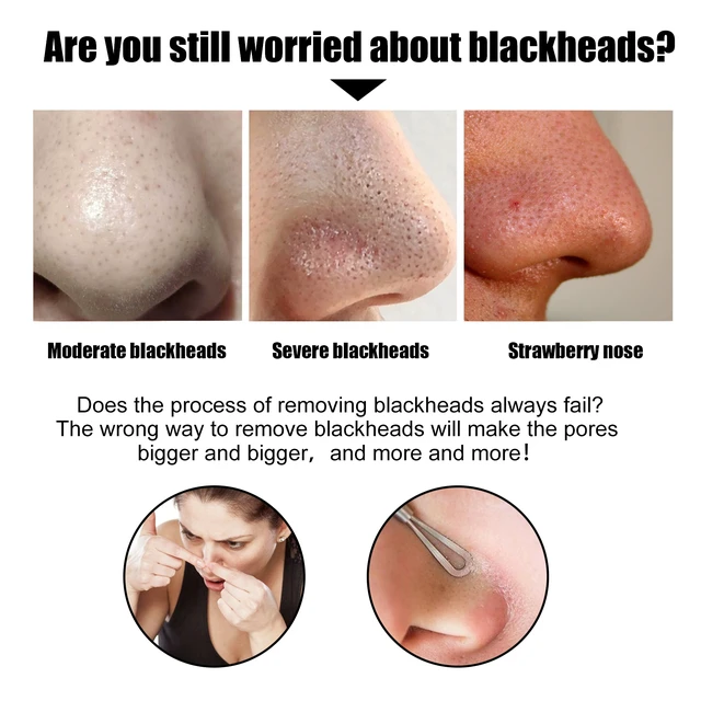 Alt view image 3 of 6 - Moisturizing & Refreshing Daily Nose Mask Patch, Oil Control, Pore Cleansing, Bamboo Charcoal Nasal Strips for Blackhead & Acne Removal