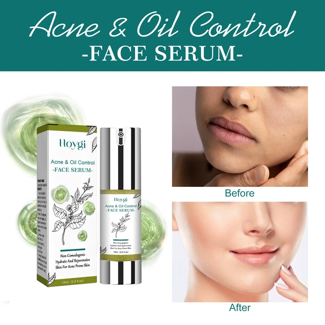 Alt view image 3 of 6 - Tea Tree Oil Face Serum Hydrating Brightening Firming Pore Minimizing Anti-Aging Essence