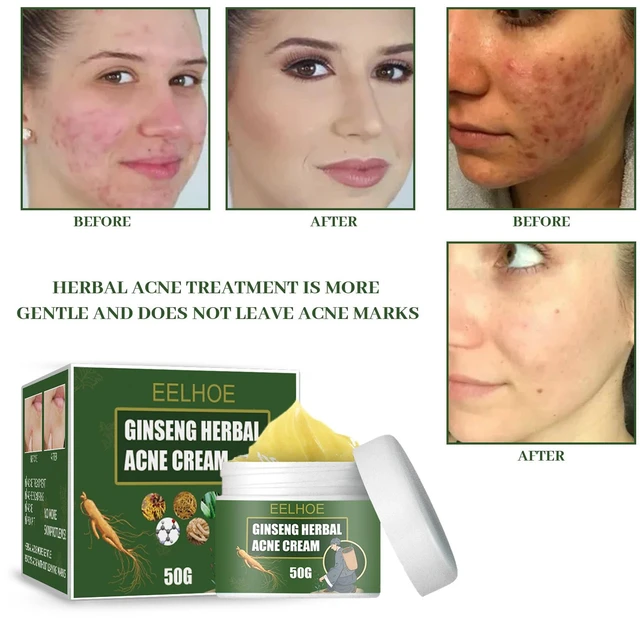 Alt view image 3 of 5 - Herbal Acne Care Cream Moisturizing Hydrating Cleanser Water-Oil Balance Fade Acne Marks