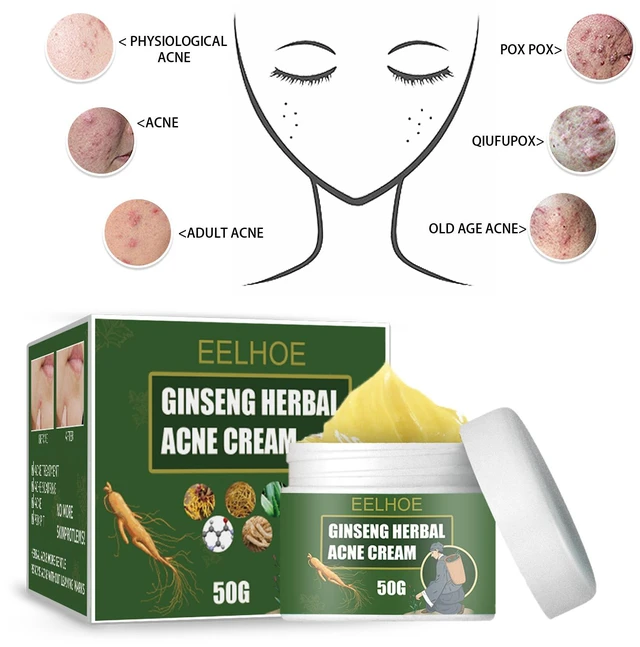 Alt view image 2 of 5 - Herbal Acne Care Cream Moisturizing Hydrating Cleanser Water-Oil Balance Fade Acne Marks