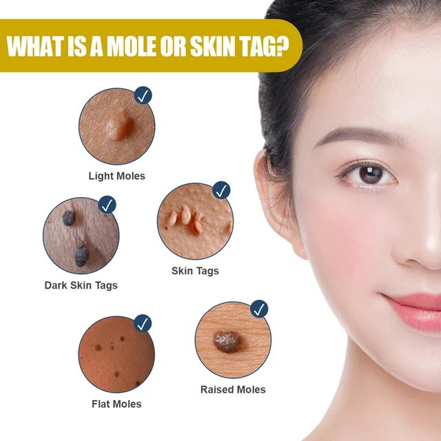 Alt view image 3 of 7 - Eye Area Safe, Targets Neck and Flat Warts, Clover Extract for Mole Removal & Skin Repair