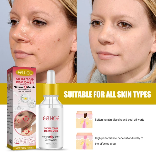 Alt view image 2 of 7 - Eye Area Safe, Targets Neck and Flat Warts, Clover Extract for Mole Removal & Skin Repair