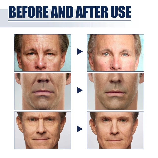 Alt view image 4 of 6 - Men's Forehead Wrinkle Reduction Patch for Fine Lines and Crow's Feet - Skin Tightening Latex Strips