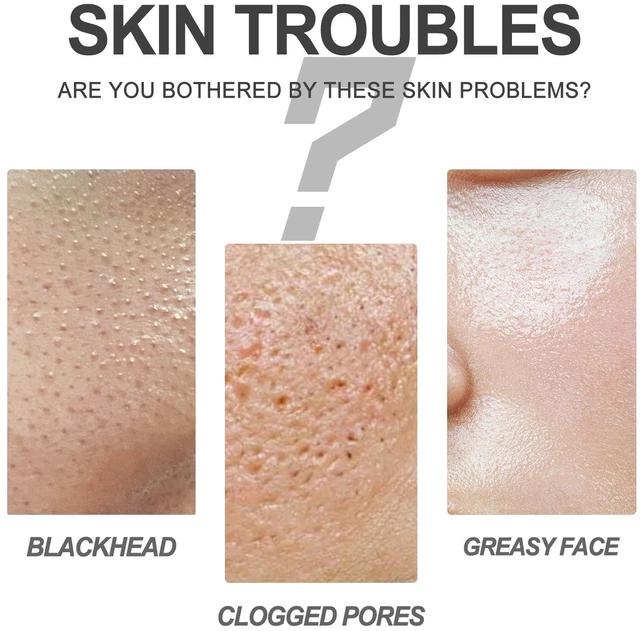 Alt view image 3 of 6 - Tea Tree Oil Blackhead Removal Kit Pore Minimizing Hydrating Essence