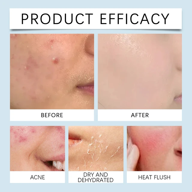 Alt view image 3 of 6 - Hyaluronic Acid Facial Roller Essence for Radiant Skin & Pore Refining