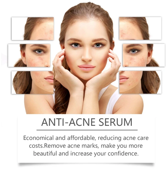 Alt view image 3 of 6 - Niacinamide Acne Care Serum Gentle Blemish Treatment Hydrating Skin Repair Essence