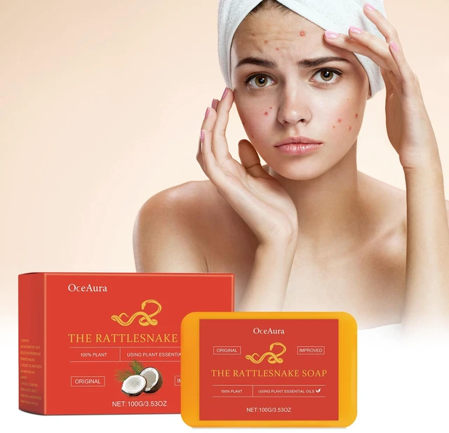 Alt view image 2 of 6 - Handmade Acne Treatment Soap for Oil Control & Pimple Removal - Foaming Vegetable Oil Cleansing Bar