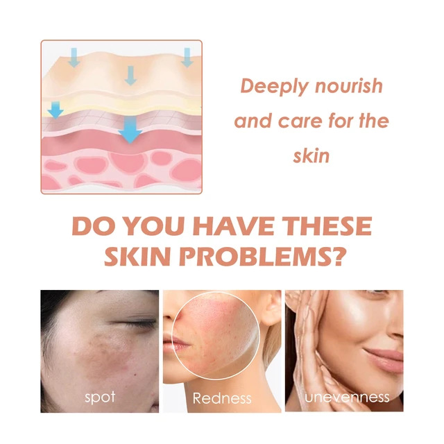 Alt view image 2 of 5 - Non-Greasy Hydrating Formula, Radiant Concealer Cream - Acne Fade & Skin Tone Brightening