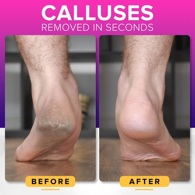 Alt view image 2 of 7 - RUSTPROOF Foot File Callus Remover for Feet with Catcher | XL Size | MegaFile Hard Skin Remover Foot Scraper for Wet and Dry Use - Non-Slip Textured Grip for Smooth, Soft & Callus-Free Feet