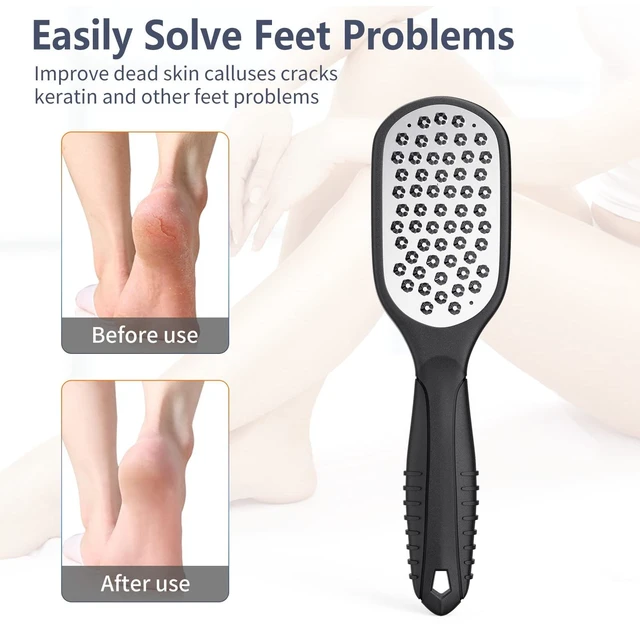 Alt view image 4 of 6 - Foot Rasp Foot File and Callus Remover. Professional Foot Care Pedicure Stainless Steel File to Remove Hard Skin.