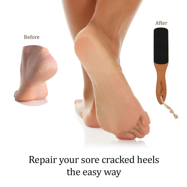Alt view image 5 of 7 - Foot File with Handle Pumice Stone for Dry Dead Skin - Callus Remover for Feet Double-Sided Foot File for Callus, Cracked Heels, Dead, and Dry Skin Removal
