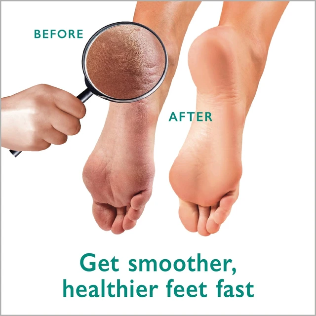 Alt view image 7 of 7 - Callus Remover Gel + Foot Scrubber Kit - Pedicure Tools for Dry Cracked Heels