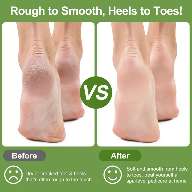 Alt view image 4 of 7 - Pumice Stone for Feet, 3 Pack Natural Earth Lava Foot Callus Remover | Pedicure Exfoliator Tools for Heels, Soles and Toe Gaps, Foot Scrubber for Dry & Dead Skin