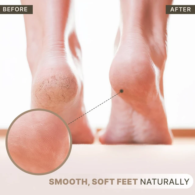 Alt view image 4 of 7 - Pumice Stone for Feet - Natural Lava Stone Foot Exfoliator | Callus Remove for Feet, Hands & Dead Skin, Foot Scrubber for Pedicure & Cracked Heels
