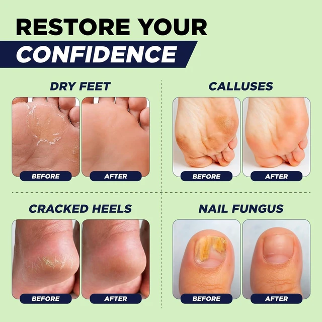 Alt view image 5 of 7 - Tea Tree Callus Remover Gel & Foot Soak, Foot Cream for Dry Cracked Feet | Extra Strength Callus Remover Gel kit for Dry Cracked Heels, Foot Cream Hydrate Softens Calluses & Rough Skin - 4in1