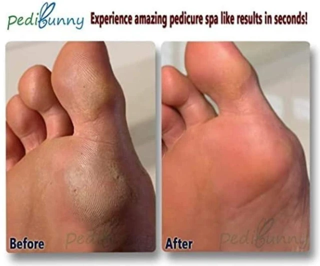 Alt view image 6 of 6 - Electric Foot Callus Remover - Rechargeable Electronic Foot File - Professional Pedicure Tools with 3 Rollers - Foot Scrubber for Dry Cracked Feet and Dead Skin - Foot Sander for Men and Women