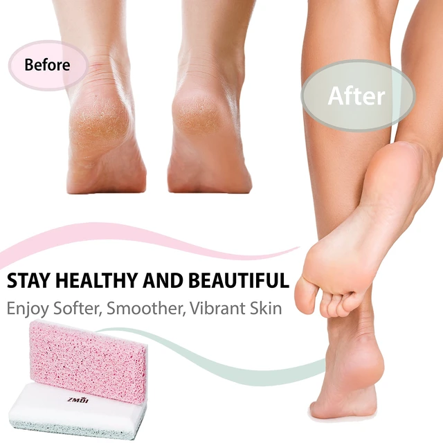 Alt view image 7 of 7 - Premium Foot File 2-in-1 Callus Remover for Feet with Dead Skin Storage + 2 in 1 Siliglass Pumice Stone Callus Remover for Feet, Elbows, Hands, and Knees