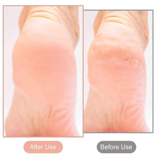 Alt view image 3 of 7 - 2 Pcs Nano Foot File Glass Nail File Foot Scrubber Callus Remover Rough and Smooth Sides Professional Pedicure Tools at Home Heel Scraper for Dead Skin Removal Cracking Wet and Dry Feet