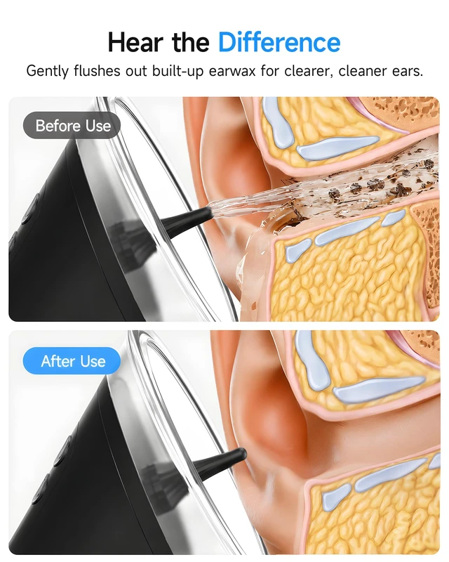Alt view image 6 of 7 - Renergy Ear Wax Removal, 3 Pressure Modes, Ear Irrigation Flushing System | Safe & Gentle Electric Ear Cleaner with IP67, 5H Runtime, 500ml Clean & Waste Tank, 12pcs Nozzles, Intelligent Memory Mode