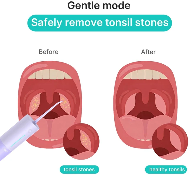 Alt view image 3 of 7 - Water Flosser Safe Tonsil Stone Remover Prevent Bad Breath, Purple | Help Prevent Infections and Bad Breath, Powerful Rechargeable Dental Oral Irrigator, IPX7