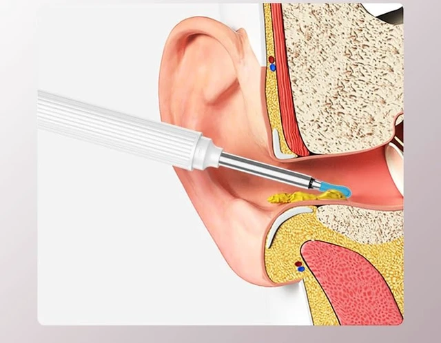 Alt view image 3 of 7 - Ear Wax Removal Tool - Earwax Remover Tool - Ear Cleaner with Camera - Earwax Removal Kit with Light - Wireless - Works with iOS & Android (Black)