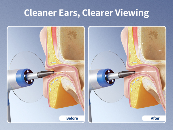 ear wax removal tool