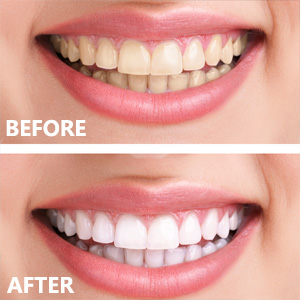 dog cat dental teeth tooth scaler cleaning tools plaque plaque remover brush for pets dogs cats