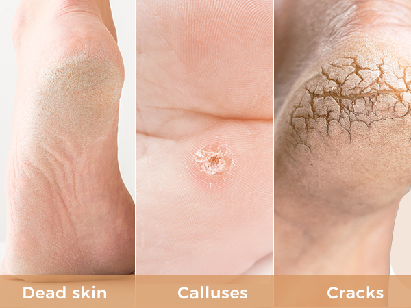 Three close-up images of foot skin conditions: dry, flaky skin labeled 'Dead skin', a rounded growth labeled 'Calluses', and cracked, rough skin labeled 'Cracks'.