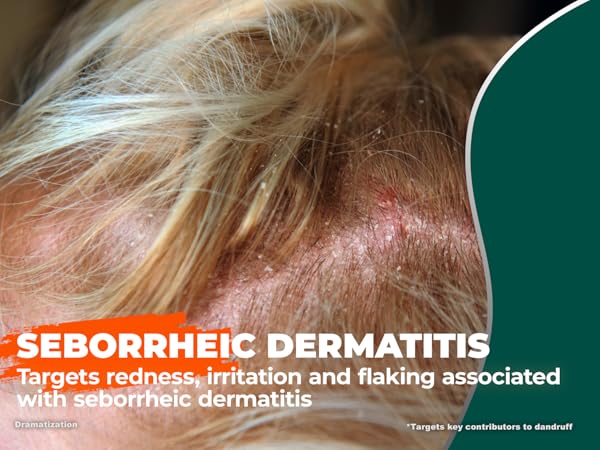 Seborrheic dermatitis shampoo for redness, irritation and flaking, scalp close-up with flakes