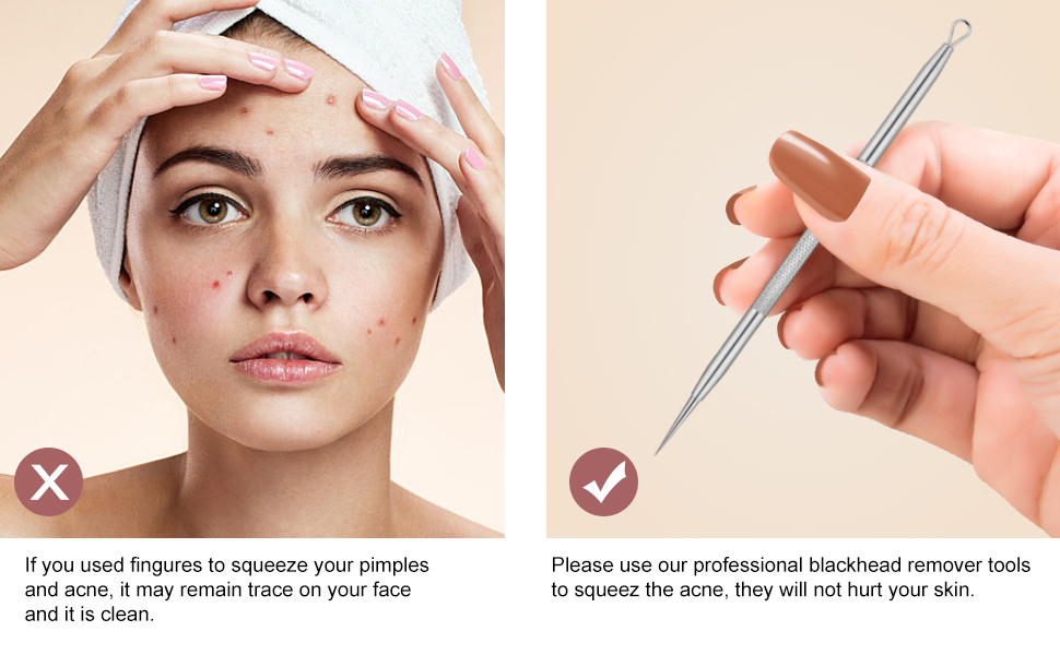 blackheads remover 