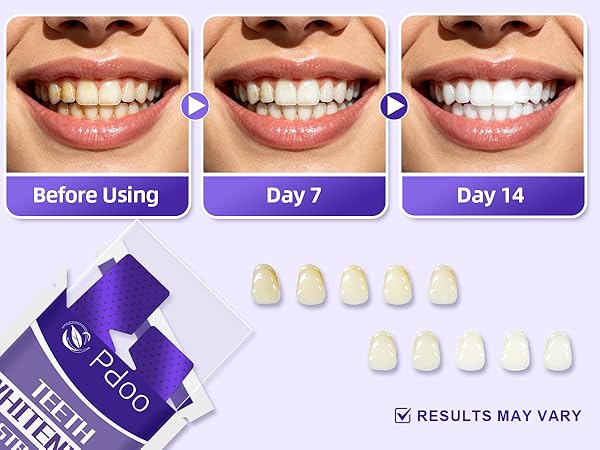 Teeth Whitening Strips