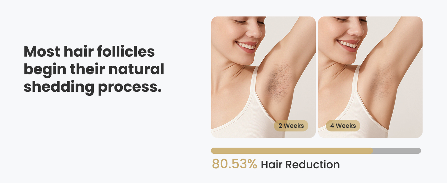 at home laser hair removal