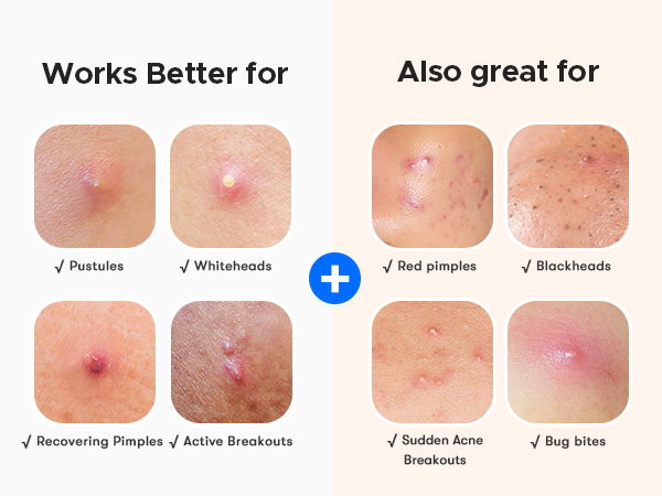 zit patches