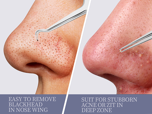 pimple extractor