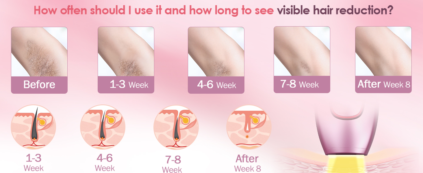 ipl hair removal device