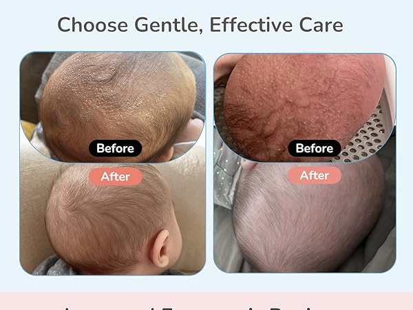 cradle cap treatment